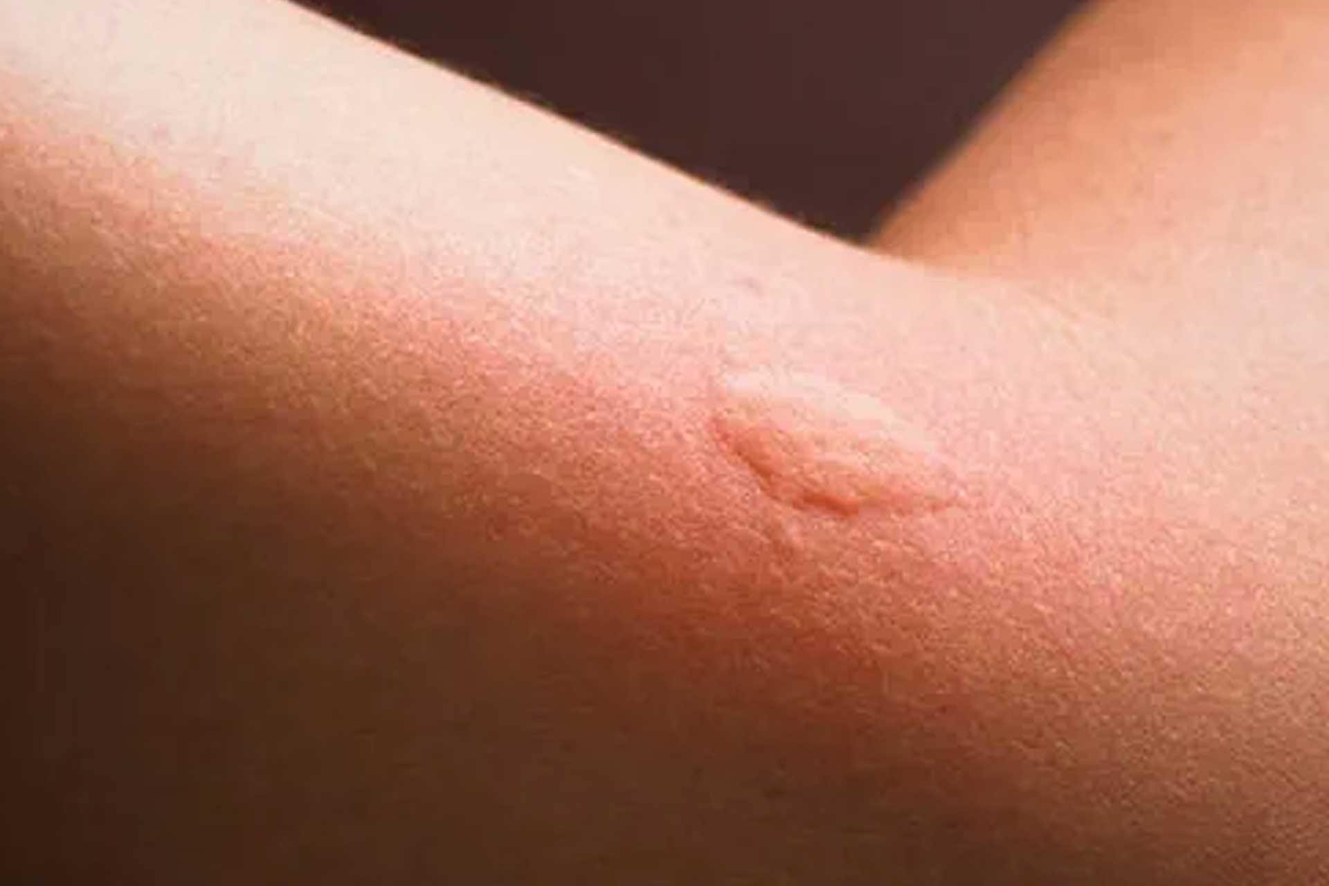 Close-up of a mosquito bite on an arm with red, swollen skin, emphasizing the need for effective mosquito control.